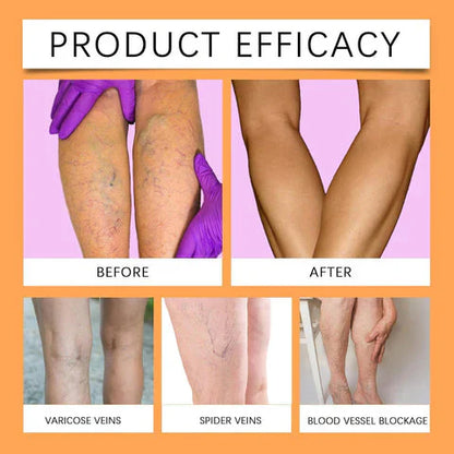 Turmeric Varicose Vein Relief🌿