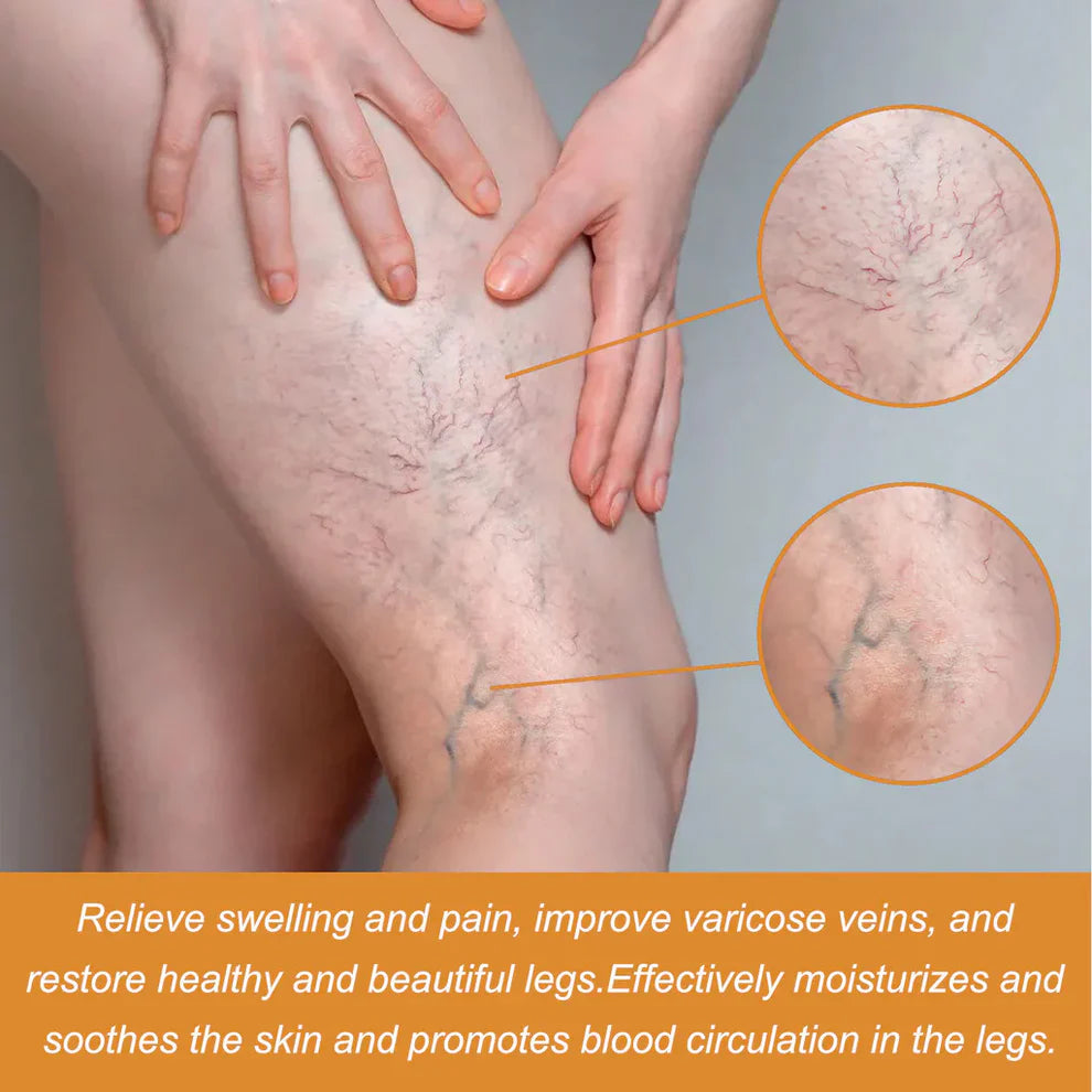 Turmeric Varicose Vein Relief🌿